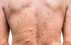 Algunos de los síntomas de la viruela símica son fiebre y sarpullidos en la piel. (Foto: Diario El Sol) 